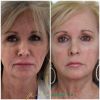 Sculptra®