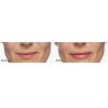 Restylane® Silk before and after