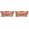Restylane® Silk before and after