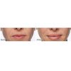 Restylane® Silk before and after