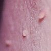 Skin Tag Excision (2 Options)