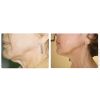 SkinTyte Laser Skin Tightening Before & After 2