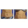 SkinTyte Laser Skin Tightening Before & After 1