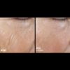 Skinbetter Science Rejuvenate Smoothing Intensive Treatment - LINES Before & After