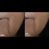 Skinbetter Science Rejuvenate Smoothing Intensive Treatment - LINES Before & After
