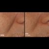 Skinbetter Science Rejuvenate Smoothing Intensive Treatment - LINES Before & After