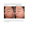 SkinMedica Rejuvenize Peel before and after