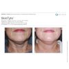 SkinTyte Laser Skin Tightening