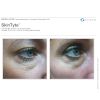 SkinTyte Laser Skin Tightening