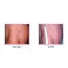 Leg & Facial Vein Treatment Consultation