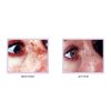 Leg & Facial Vein Treatment Consultation