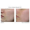 Sublative Resurfacing before and after 2