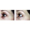 Teamine Eye Complex Before & After