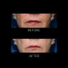 ThermiSmooth® - Face before and after