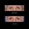 ThermiSmooth® - Face before and after