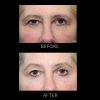 ThermiSmooth® - Face before and after