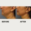 ThermiTight before and after