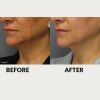 ThermiTight before and after