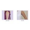 Tumescent Liposcution Before & After 1