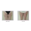 Tumescent Liposcution Before & After 3