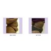Tumescent Liposcution Before & After 2