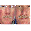 Laser Vein Therapy for Face Before and After