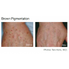 Pulsed Dye Laser Therapy (4 options)