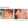 Pulsed Dye Laser Therapy (4 options)
