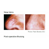 Pulsed Dye Laser Therapy (4 options)