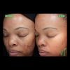 VI Peel B&A