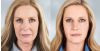Sculptra Aesthetic B&A 3