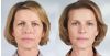 Sculptra Aesthetic B&A 1