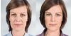 Sculptra Aesthetic B&A 2