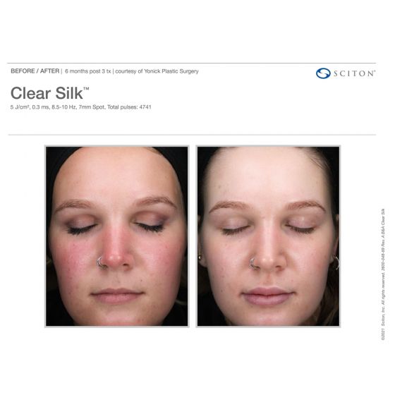 ClearSilk®