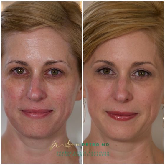 Facial Fillers