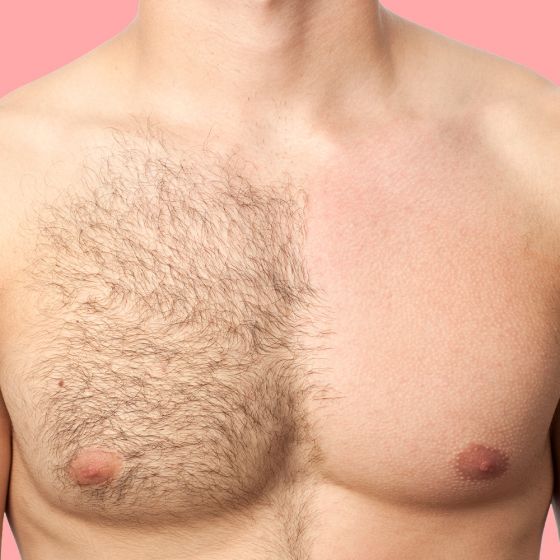 Laser Hair Removal - Men Consultation