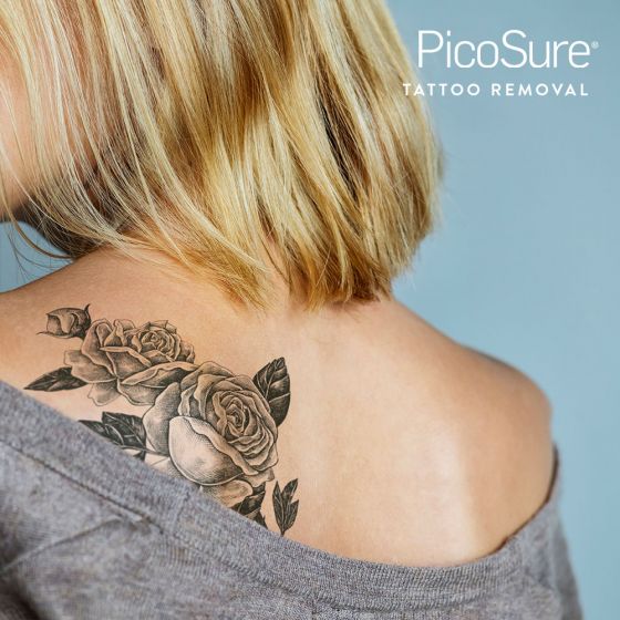 Laser Tattoo Removal Consultation