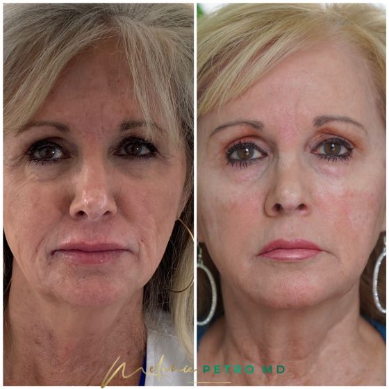 Sculptra®