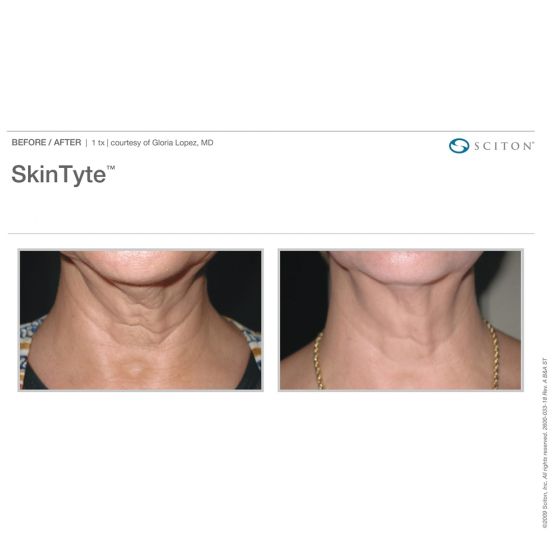 SkinTyte Laser Skin Tightening
