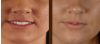 Microdermabrasion - (2 opts)