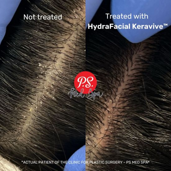 Treated with  HydraFacial Keravive BA
