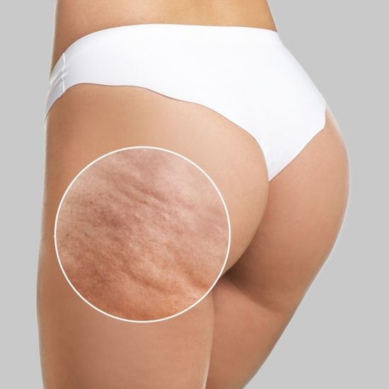 Avéli™ Cellulite Treatment