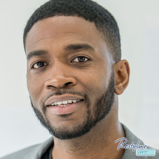 Restylane Lyft For Men