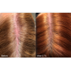 KeraLase Hair Restoration 