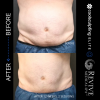 CoolSculpting® - Elite Midsection Makeover