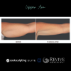 CoolSculpting® Elite Upper Arm 