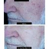 DermaV