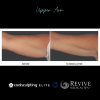 CoolSculpting® Elite Upper Arm 