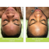 Celluma LED Light Therapy - Facial Add-On