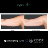 CoolSculpting® Elite Upper Arm 